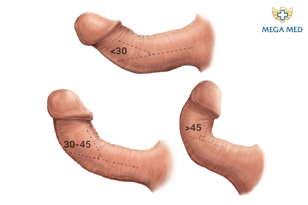Cong dương vật có thể là nguyên nhân khiến cậu nhỏ bị đau sau khi quan hệ